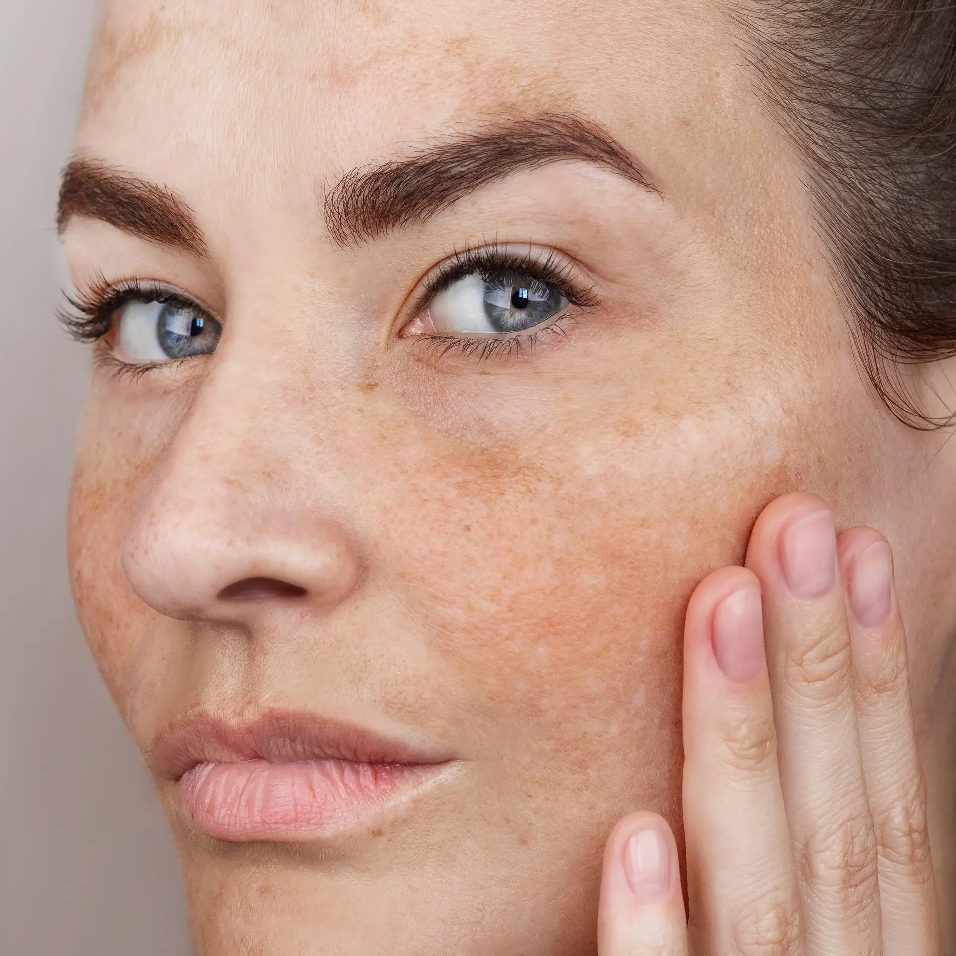 Woman with facial hyperpigmentation and dark spots