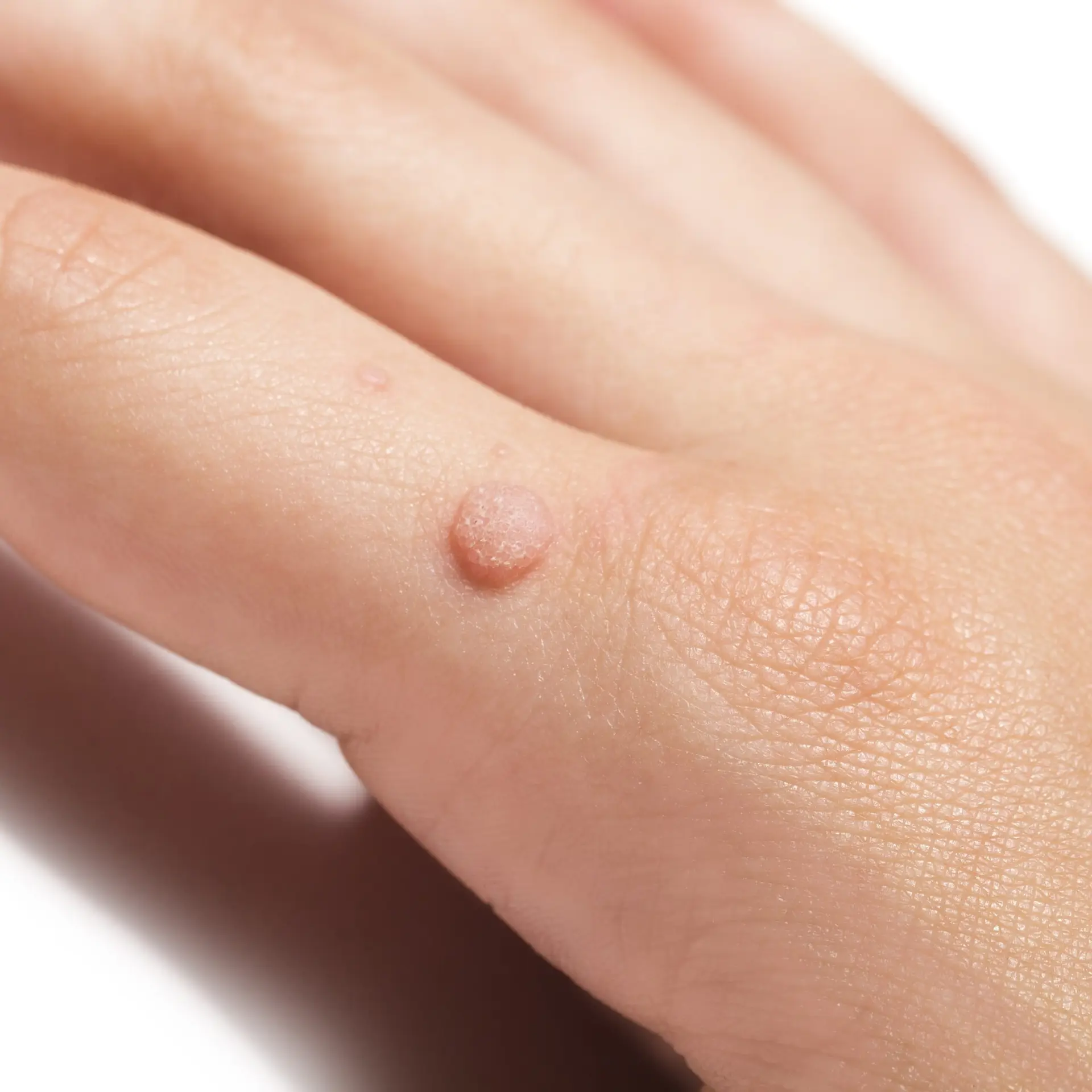 Close-up of common wart on the finger