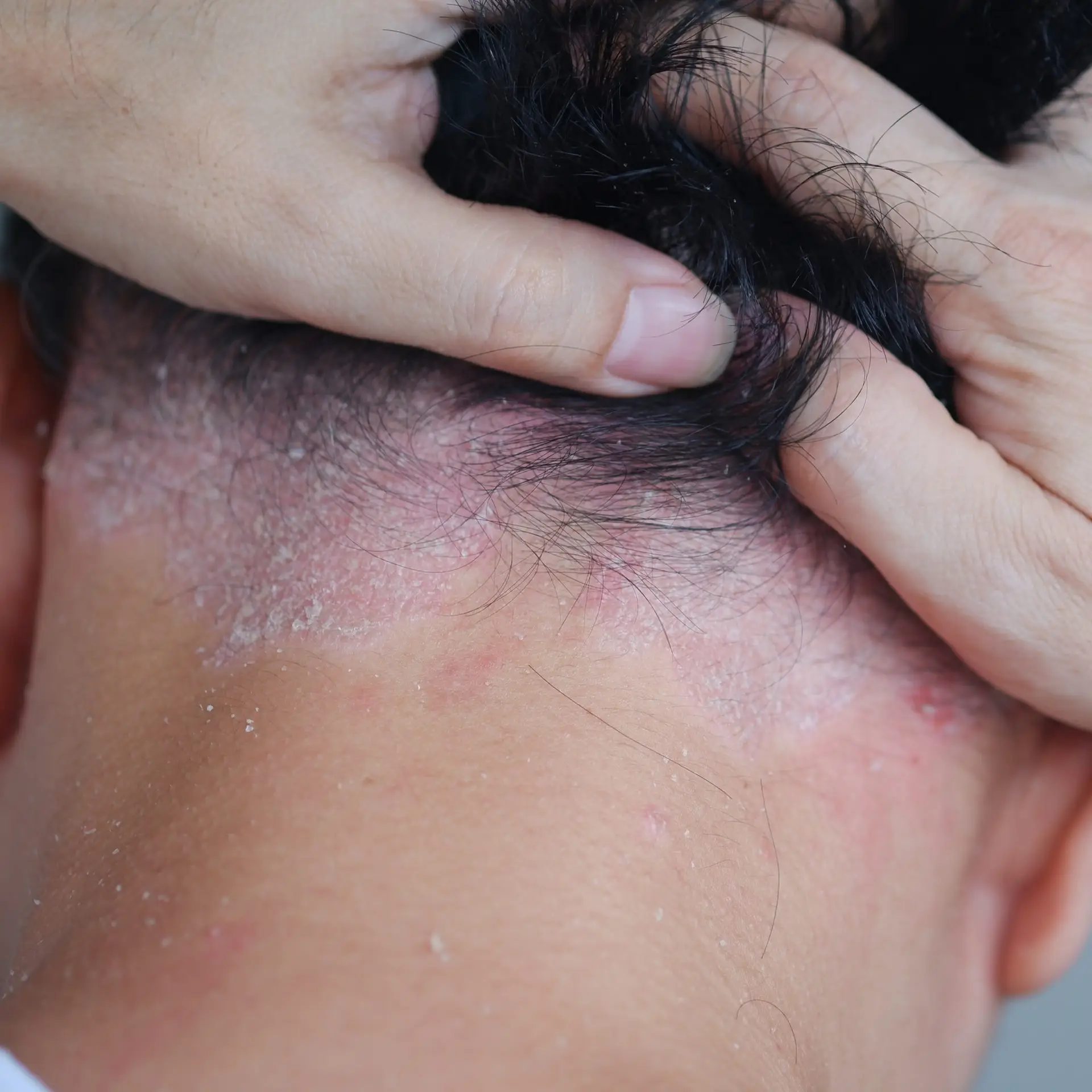 Psoriasis on the nape of a man.