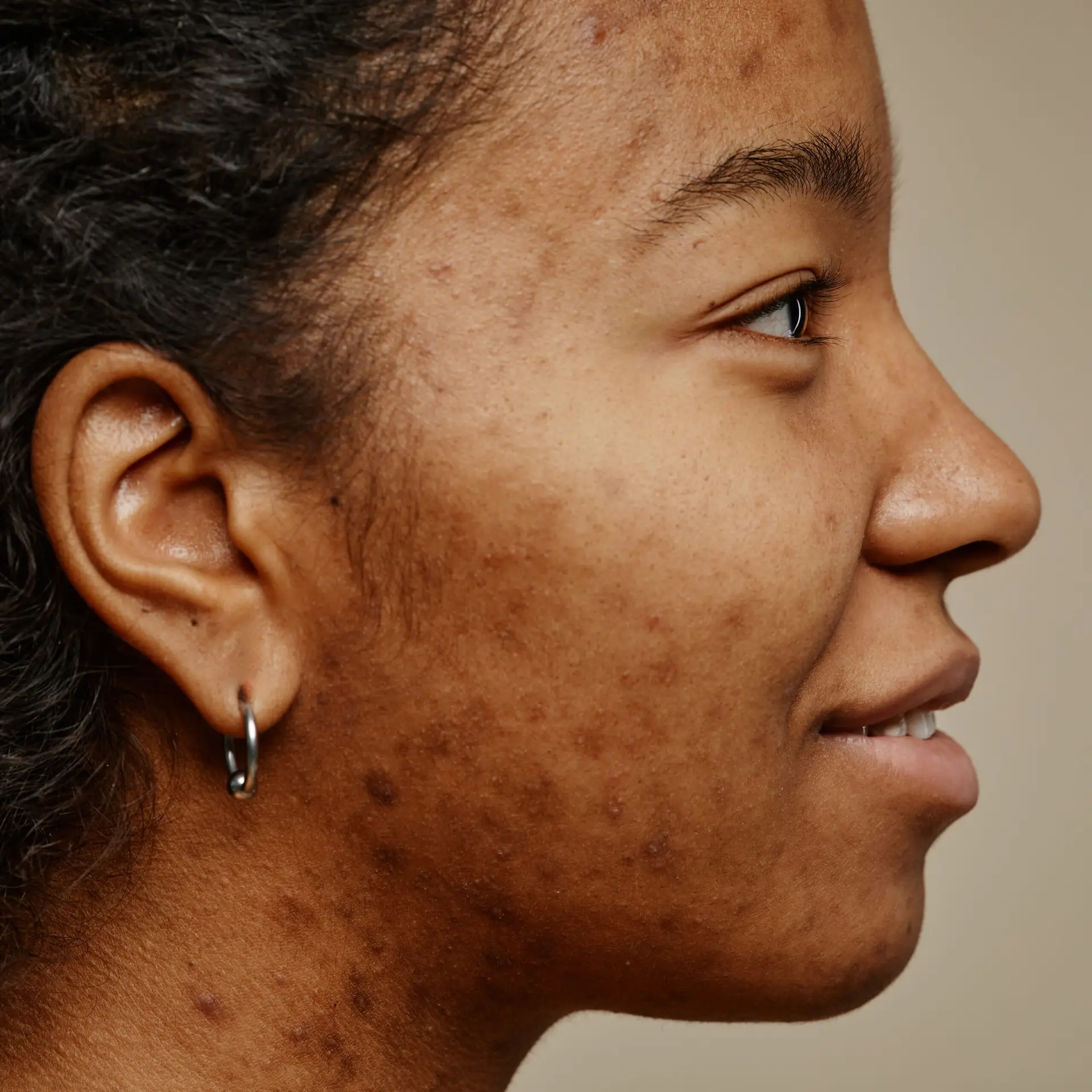 Woman with facial hyperpigmentation and dark spots