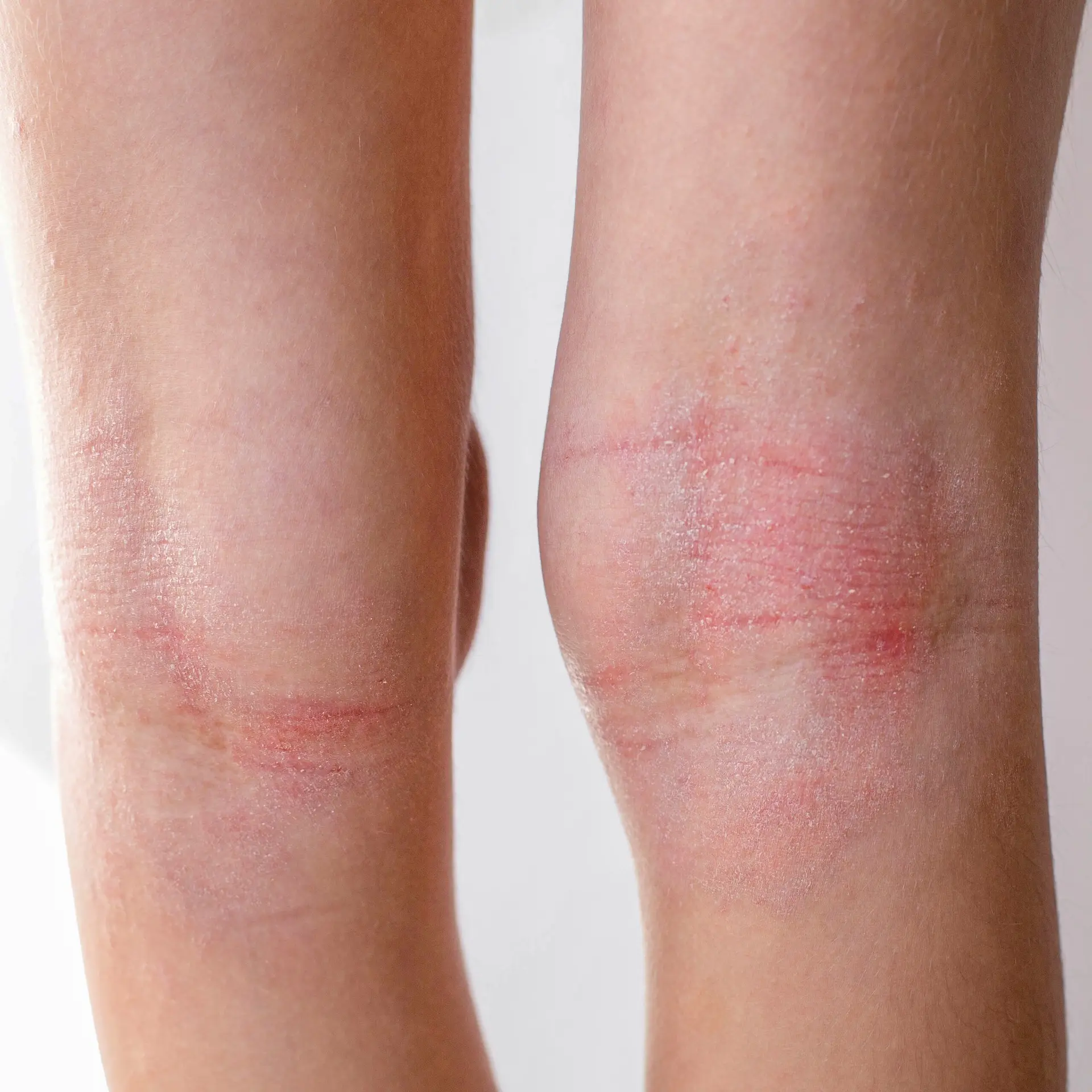 Close-up of rash on back of leg