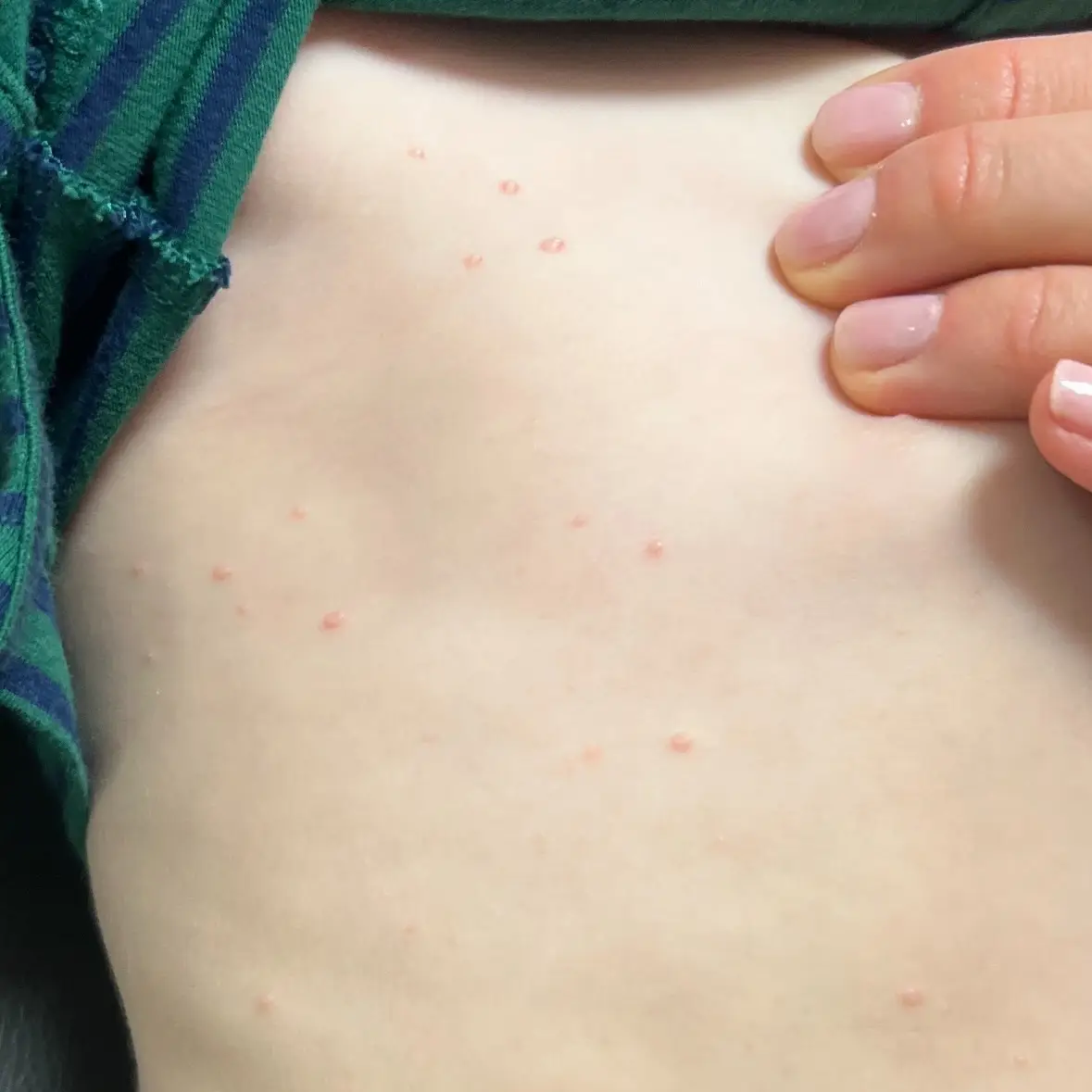 Close-up of molluscum contagiosum bumps on the skin