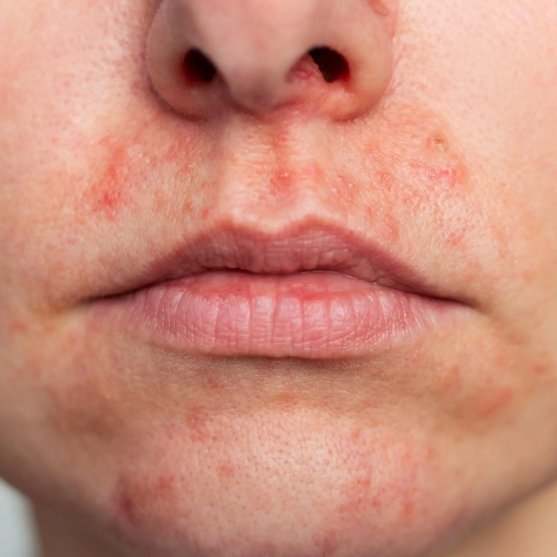 Close-up of perioral dermatitis around the mouth