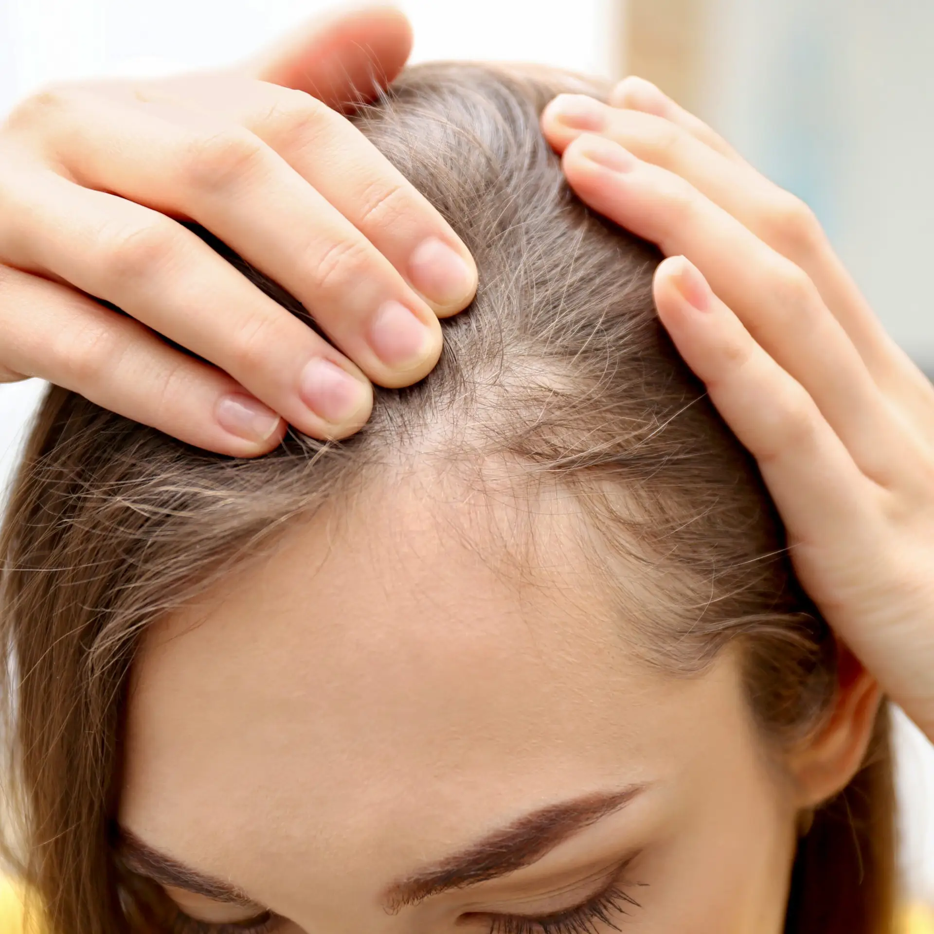 Close-up of scalp and hair thinning