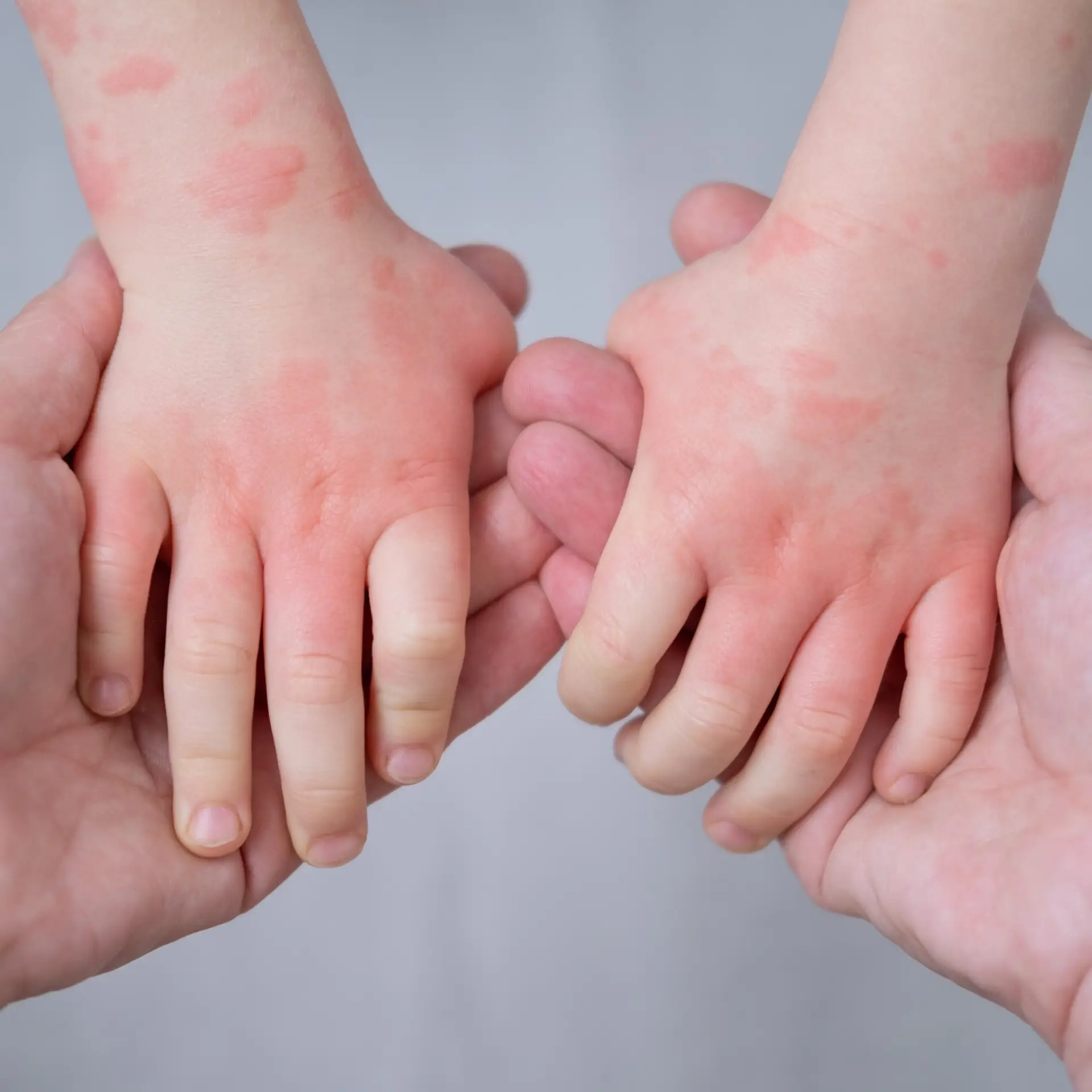 Close-up of child's hands with irritated, dry skin
