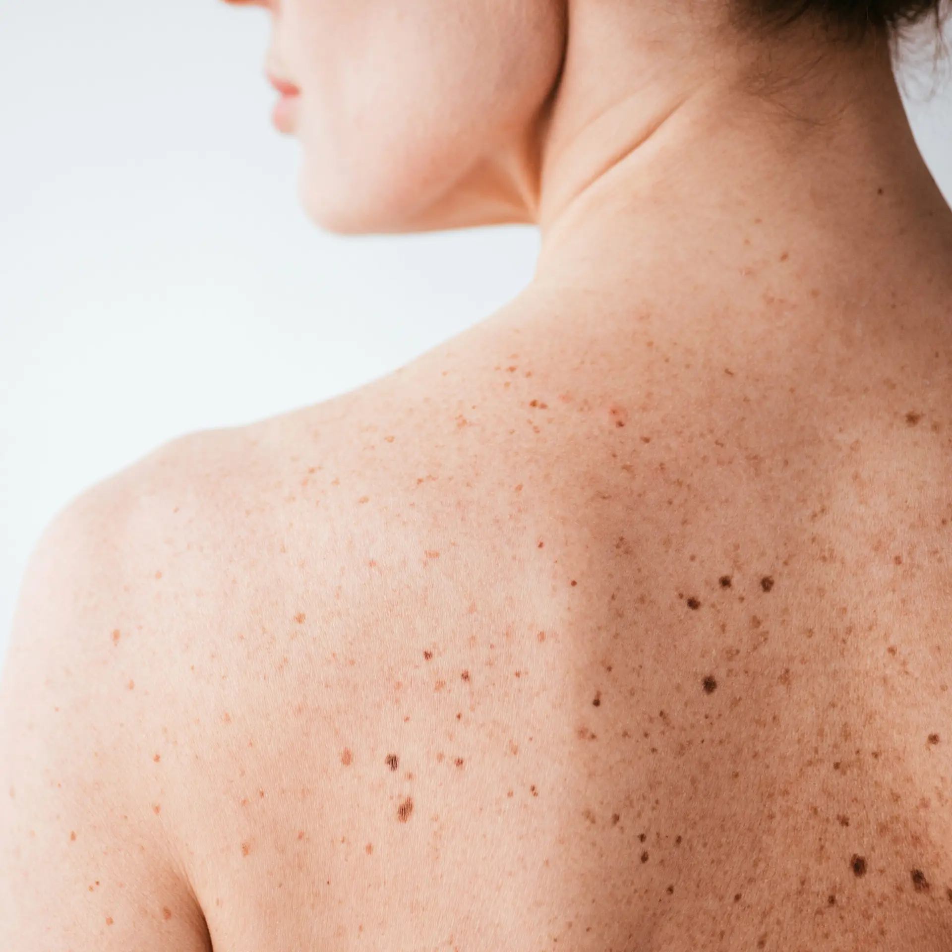 Skin check of moles on the chest and neck