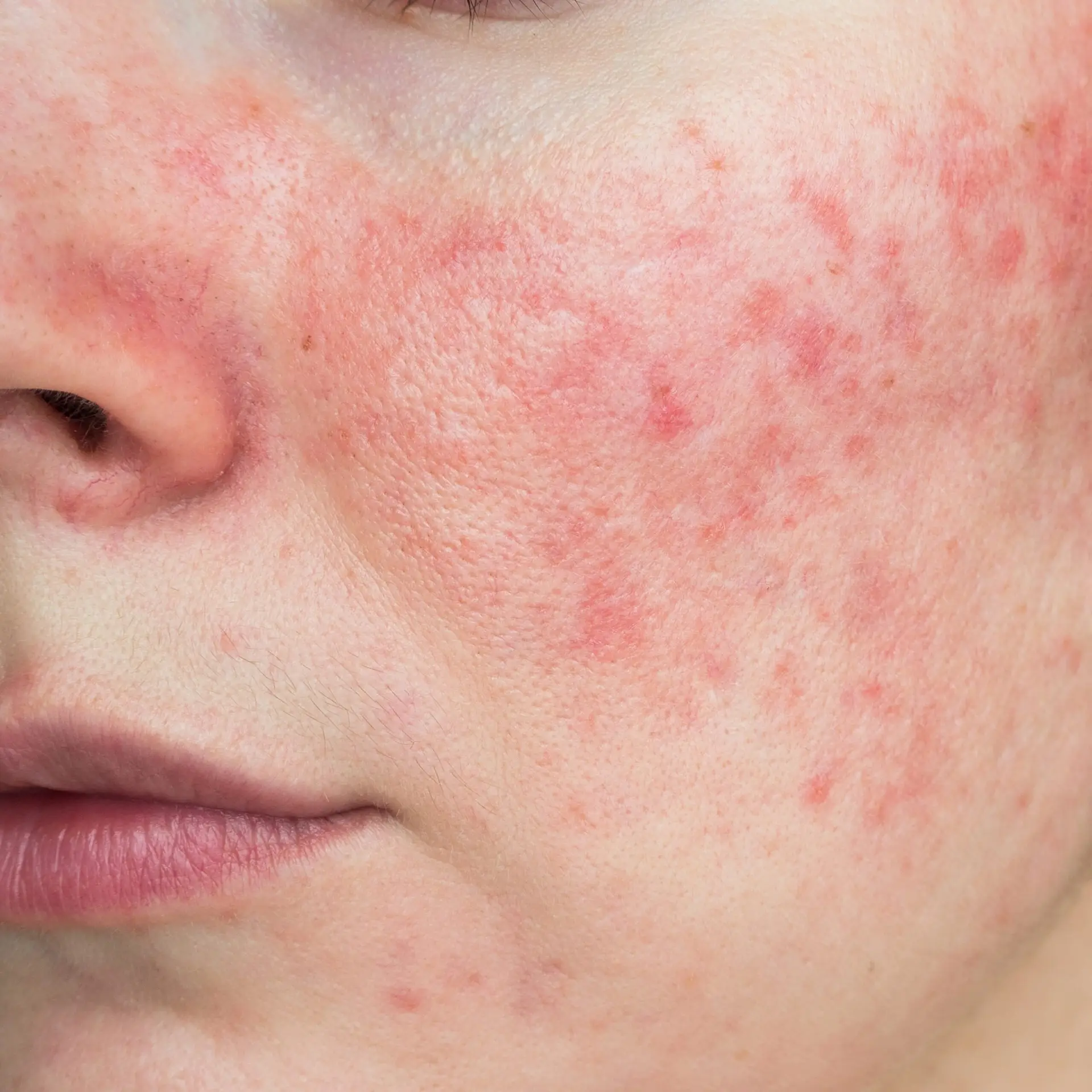 Close-up of rosacea and facial redness on the cheek